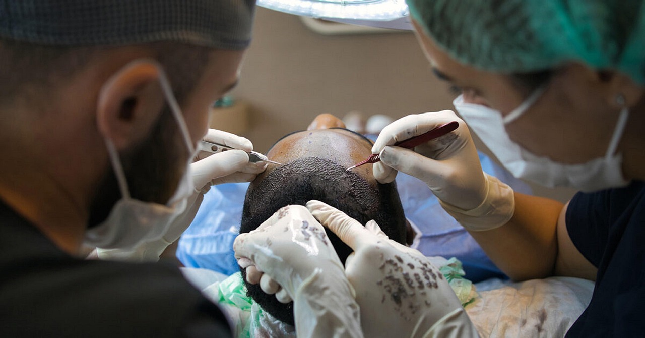 How To Find The Best Hair Transplant Surgery In Turkey?