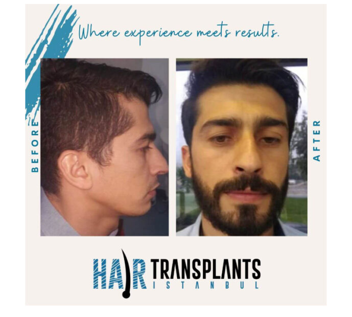 Hair Transplant In Turkey: Before And After Results