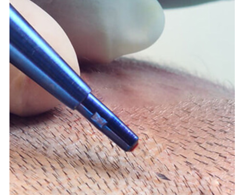 Hair Transplant In Istanbul