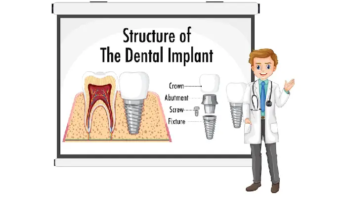 all-on-x dental implants pembroke pines