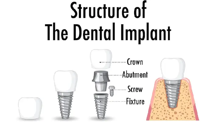 all-on-x dental implants pembroke pines