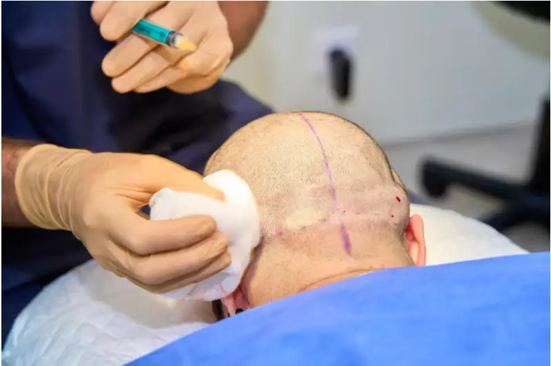How To Prepare For Your Hair Transplant Procedure?