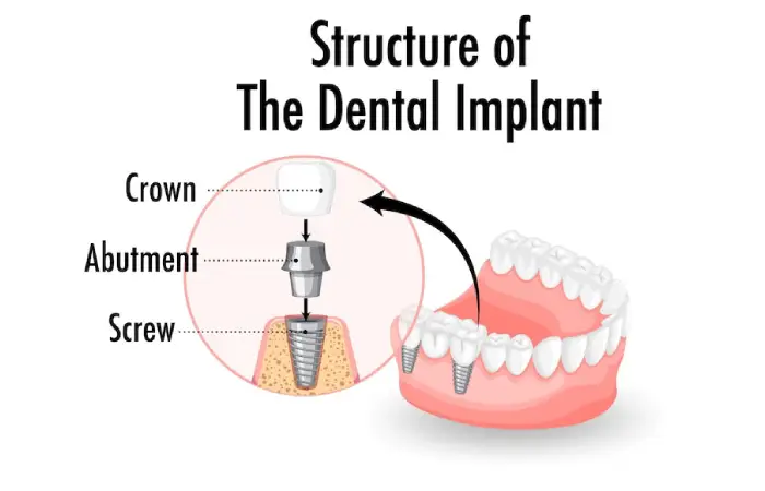 all-on-x dental implants pembroke pines