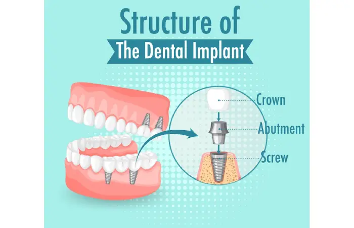 How All-On-X Dental Implants Pembroke Pines Can Transform Your Oral Health?