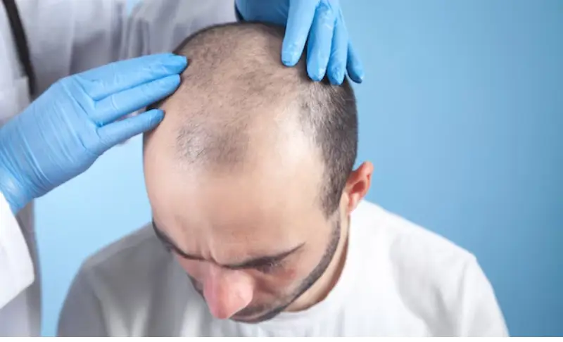 Hair Transplant in Turkey