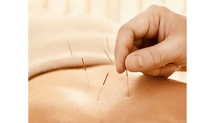TCM Akupunktur: Welche Beschwerden Lassen Sich Effektiv Behandeln?