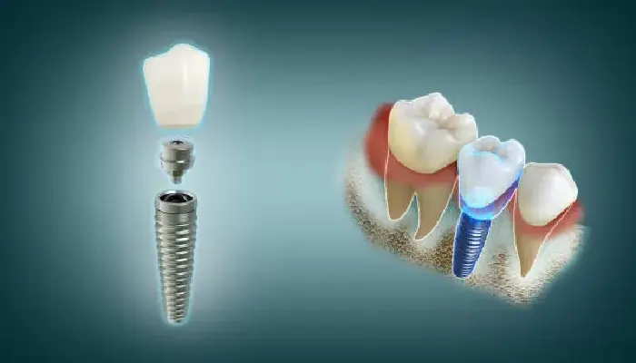 What to Expect During All-on-X Dental Implant Surgery in Pembroke Pines?